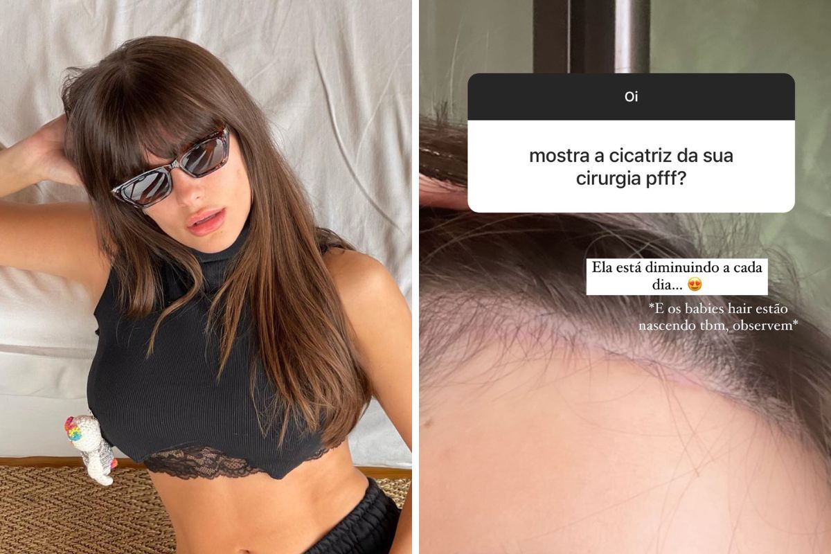 Thais Braz Atualiza F S Sobre Cirurgia Na Testa E Mostra Cicatriz Veja