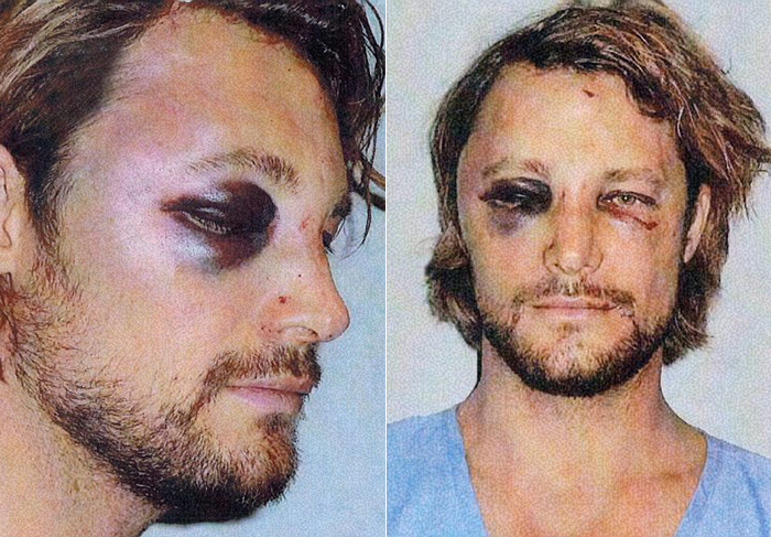 Veja o rosto desfigurado de Gabriel Aubry depois de briga na casa de Halle Berry