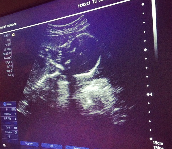 Grávida, Perlla mostra imagem de seu ultrassom no Instagram