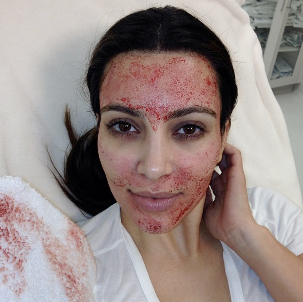 Kim Kardashian radicaliza com tratamento facial com o próprio sangue