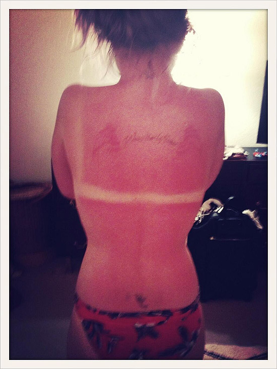 Kelly Osbourne esquece o protetor solar e mostra as costas queimadas