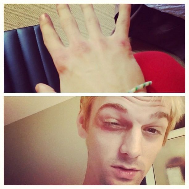 Aaron Carter posta foto de olho roxo