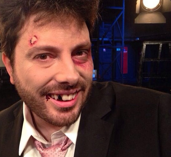 Danilo Gentili aparece machucado e sem dente