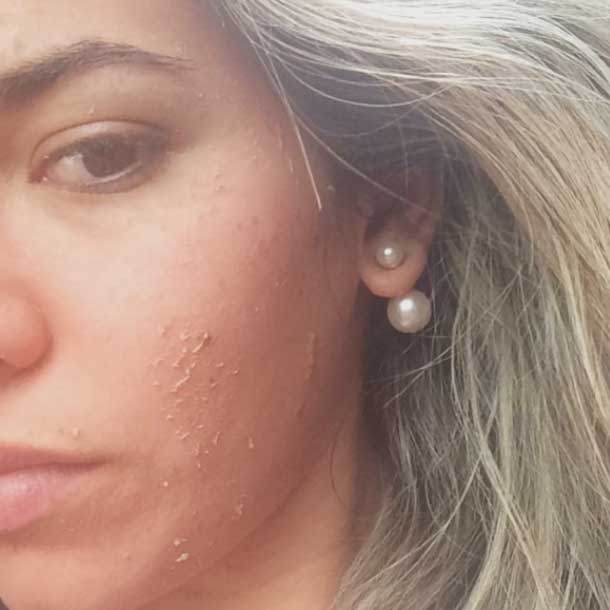  Adriana Sant'anna mostra rosto após uma sessão de peeling