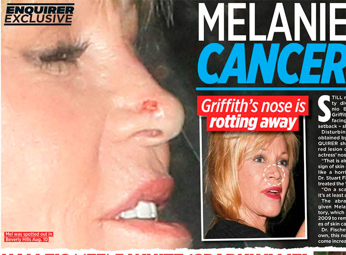Melanie Griffith pode estar com câncer de pele de novo