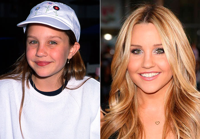 Amanda Bynes iniciou sua carreia aos 10 anos de idade e foi parar em um programa do canal fechado Nickelodeon. Crescendo em frente às câmeras, a atriz bombou depois de fazer o filme Tudo que Uma Garota Quer, e passou a desenvolver problemas com drogas e álcool. Além disso, Amanda passou a apresentar um comportamento estranho, assumindo ter transtorno bipolar e maníaco depressivo. Ela chegou a ser internada em clínicas para se tratar e seus pais passaram a ter a guarda de seus bens, mas logo ela conseguiu na justiça o direito de poder controlar tudo o que tem. Recentemente, ela apareceu em alguns cliques no instagram de um amigo, e parecia estar com uma aparência mais saudável.