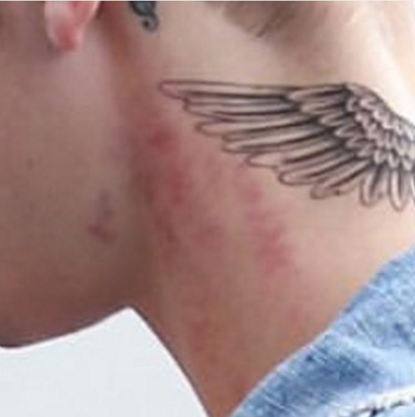 Justin Bieber aparece com 'chupão' no pescoço