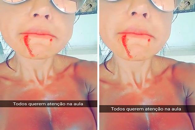 Gracyanne Barbosa é atingida por cão e tem a boca cortada