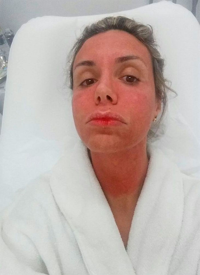 Renata Banhara faz tratamento e fica com a pele vermelha