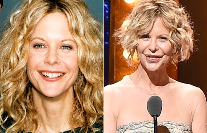 Meg Ryan fez ou não cirurgia plástica? Médico responde,