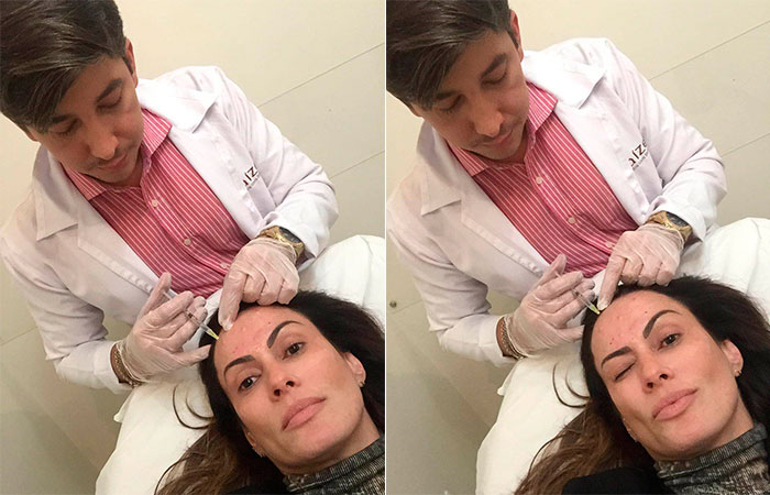  Nubia Olliver recorre ao botox: 'Não vivo sem'