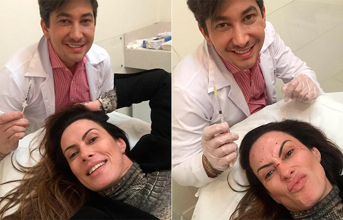  Nubia Olliver recorre ao botox: 'Não vivo sem'