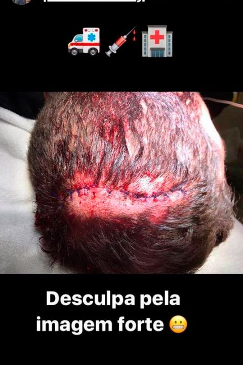 Pedro Scooby machuca a cabeça surfando em Portugal 