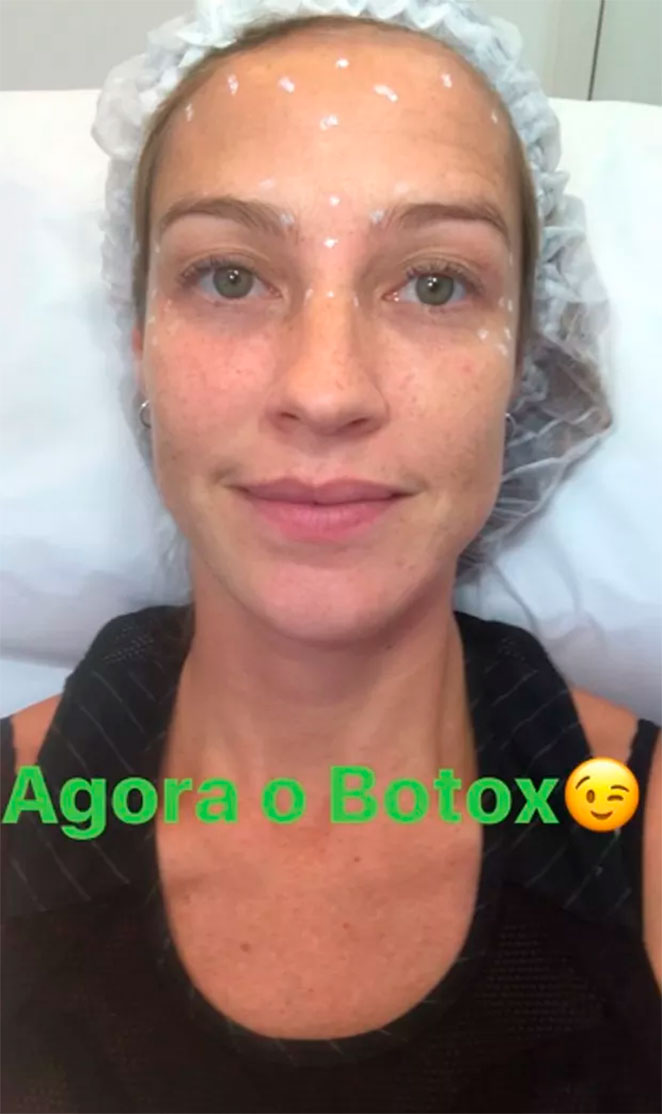 Luana Piovani aplica botox: ‘Perfeição não existe’