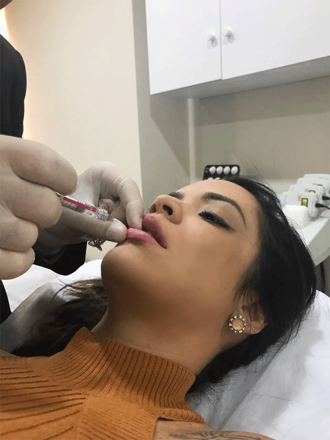 Denise Dias aumenta os lábios inspirada em Kylie Jenner