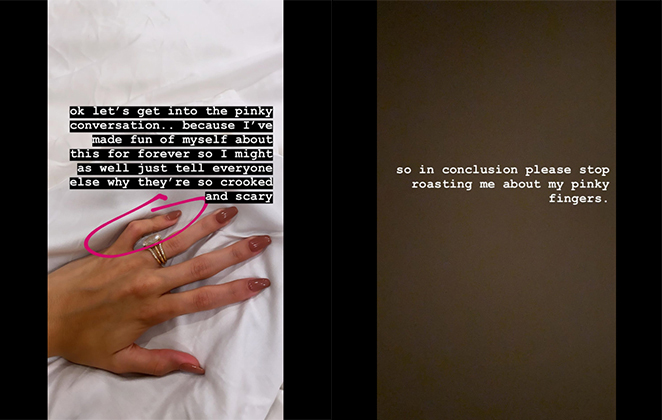 Hailey Bieber explicou porque seus dedos são tortos nos stories do Instagram