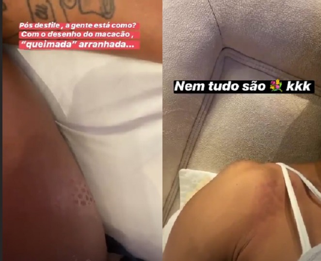 Gracyanne Barbosa mostrou machucados após desfilar na Sapucaí