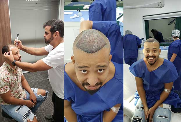 O ator Antônio Carlos Santana, o Mussunzinho, durante seu transplante capilar