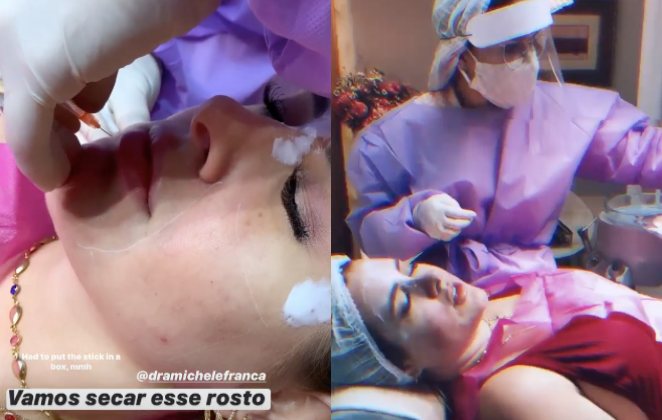 Patricia Leitte mostra aplicação de emagrecimento facial em seu Instagram