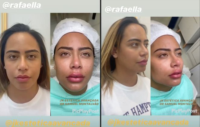 Médico mostra antes e depois de Rafaella Santos