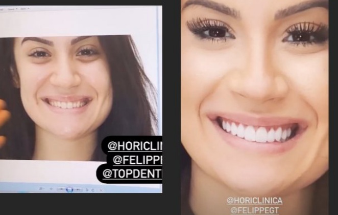 Bianca Andrade mostra 'antes e depois' de seu sorriso 