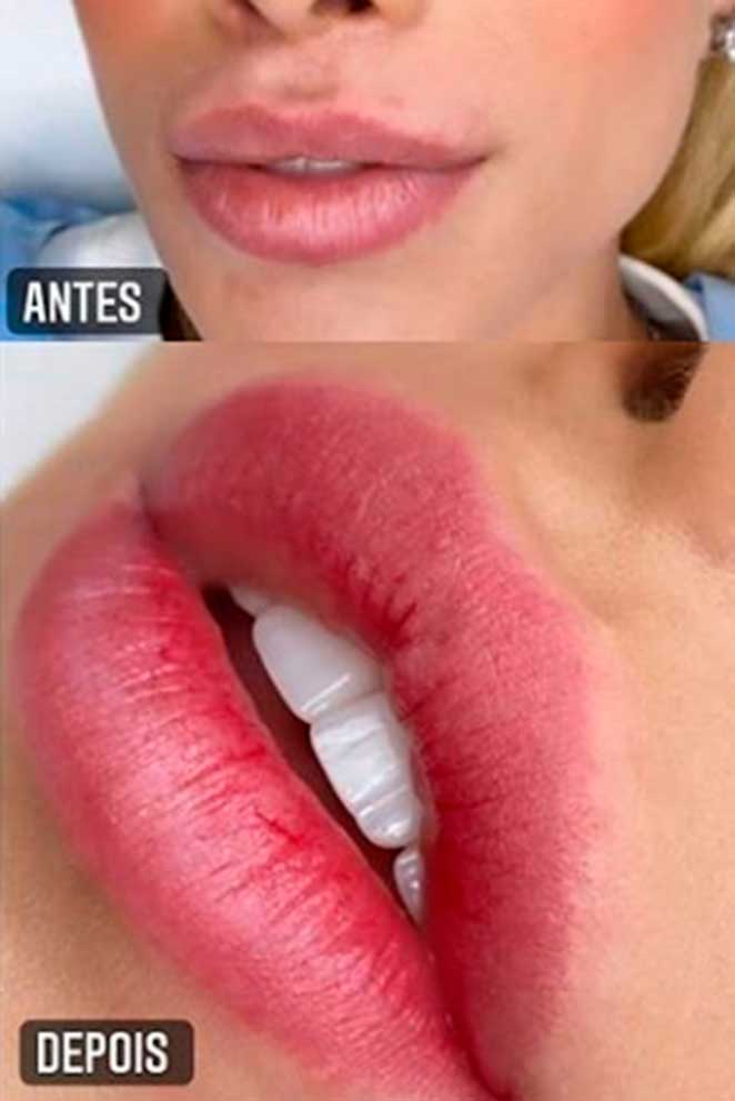 Comparativo das bocas de Flávia Pavanelli após procedimento de lábios infinitos