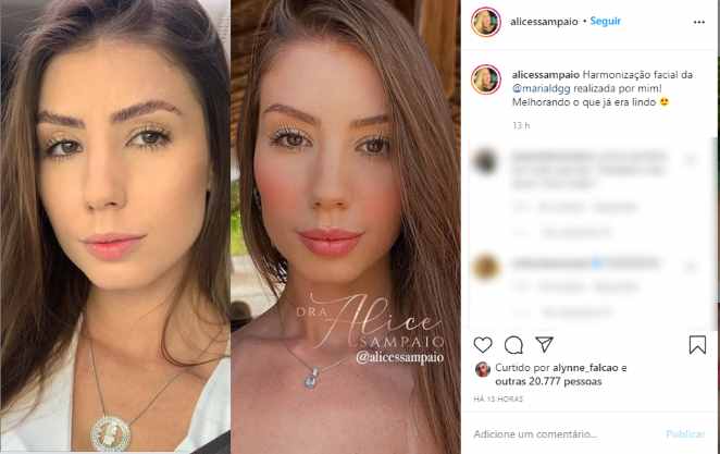 Antes E Depois Affair De Whindersson Faz Harmonizacao Facial O Fuxico