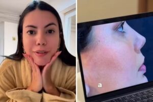 Fernanda Bande faz plástica no nariz