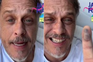 Guilherme Fontes exibe dedo com picada de cobra