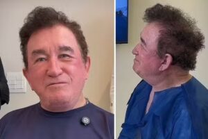 Amado Batista faz transplante capilar