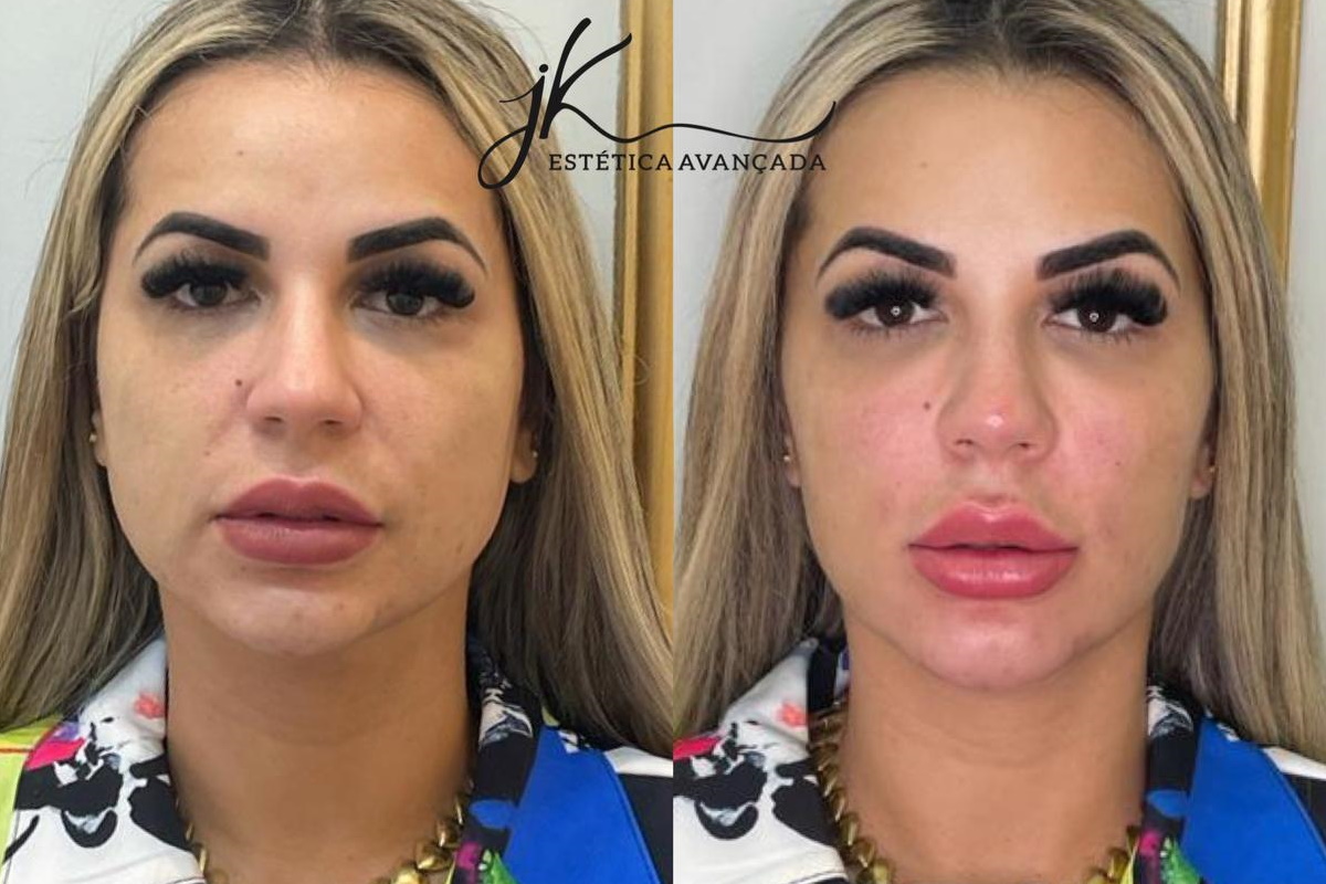 Deolane Bezerra antes e depois de harmonização facial
