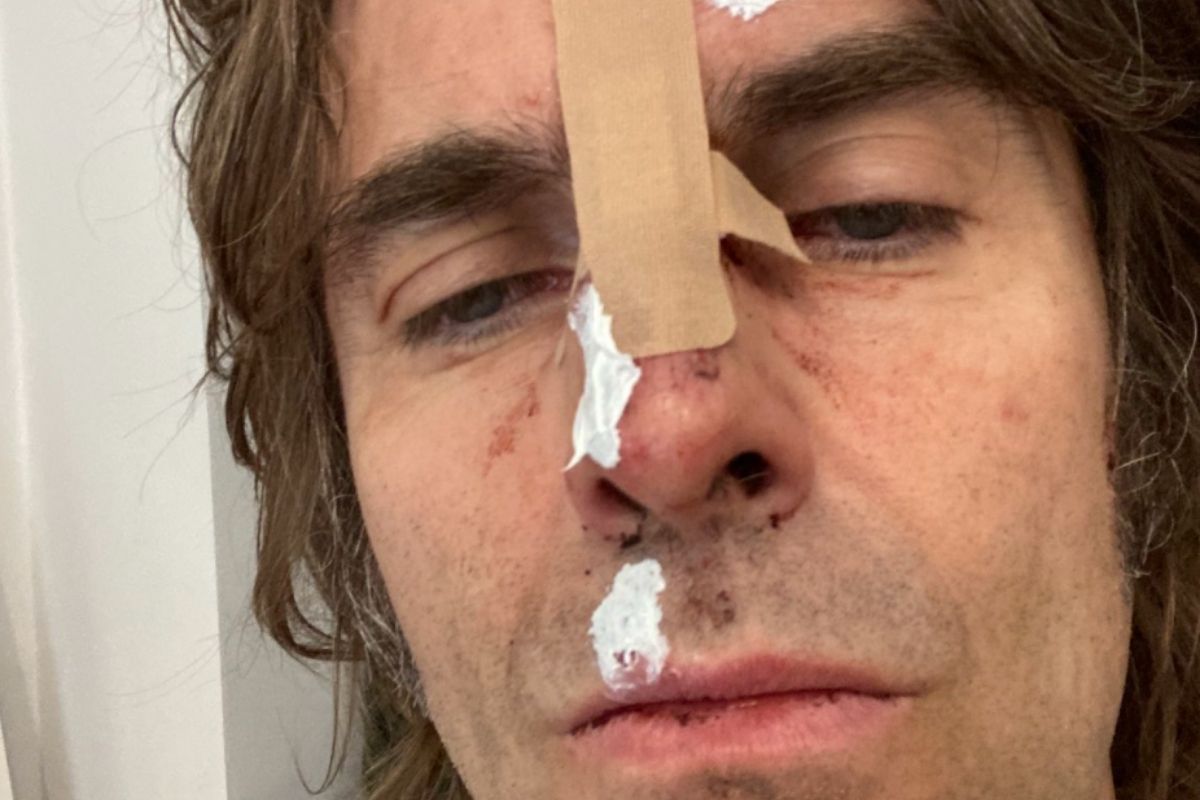Liam Gallagher machucado
