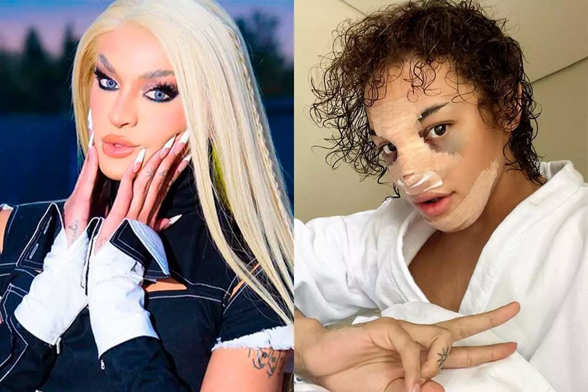 Pabllo Vittar choca fãs ao aparecer com rosto inchado e cheio de curativos