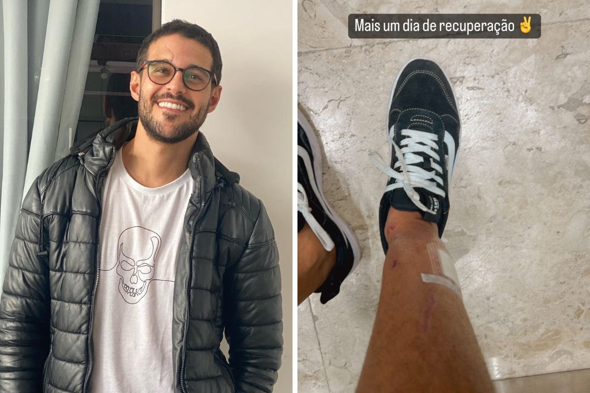 Rodrigo Mussi mostra cicatrizes após acidente