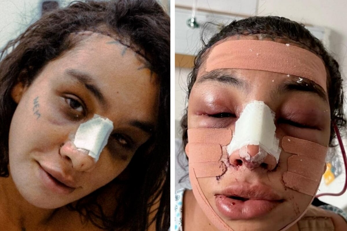 Linn da Quebrada com o rosto inchado e com curativo após cirurgia