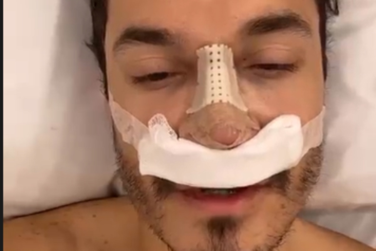 eliezer com curativo no nariz após cirurgia de rinoplastia