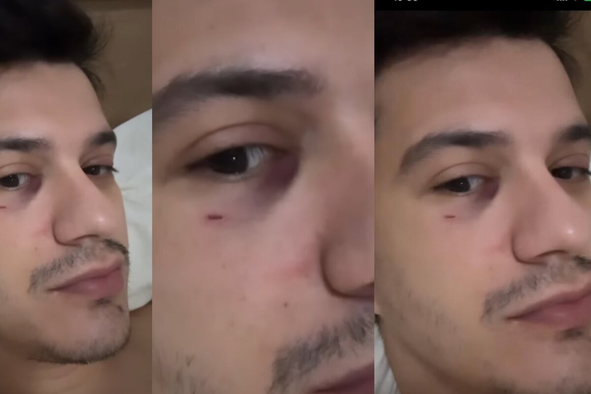 Sertanejo Hugo com o olho roxo e machucado