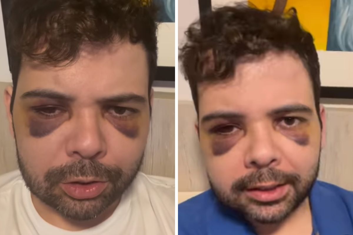 Gustavo Mendes mostra hematomas após assalto