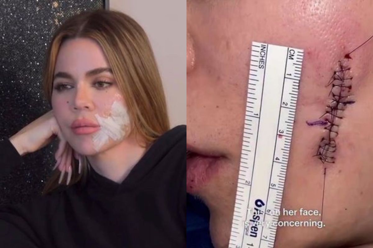 Khloe Kardashian mostra cicatriz de retirada de melanoma