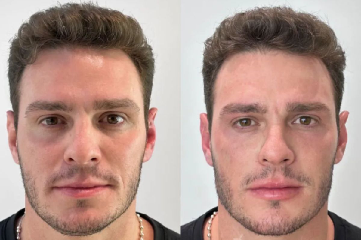 Gustavo Benedeti antes e depois da harmonização facial
