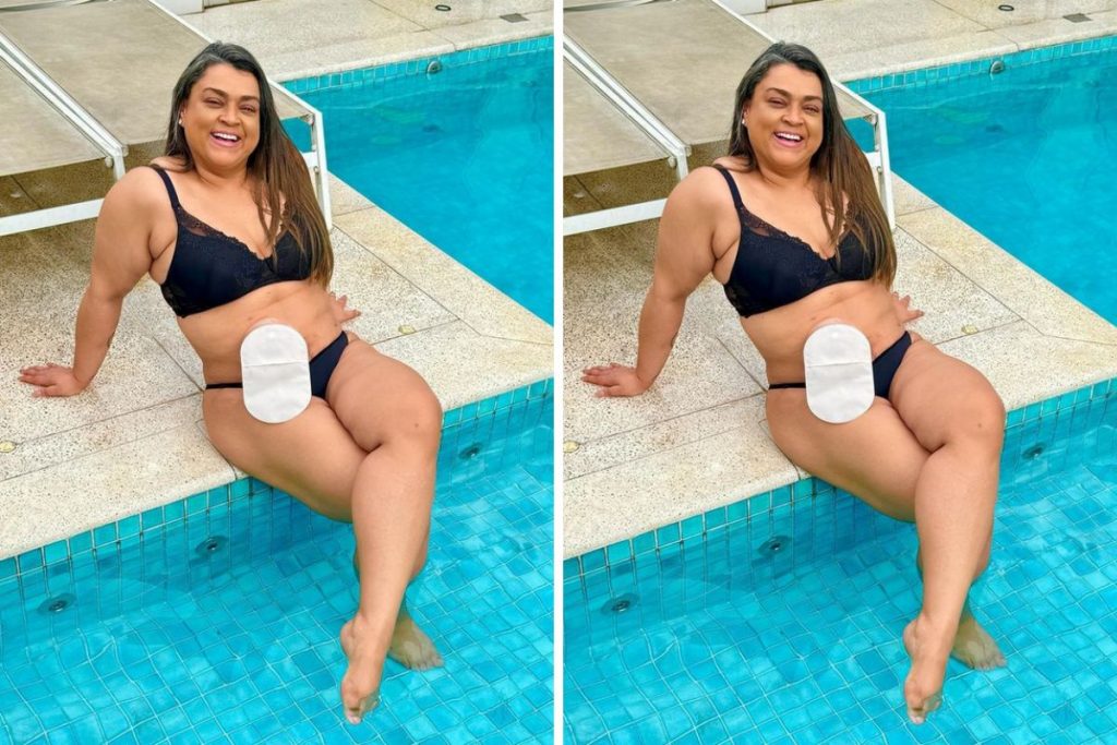 Preta Gil se despede de bolsa de ileostomia com foto na piscina