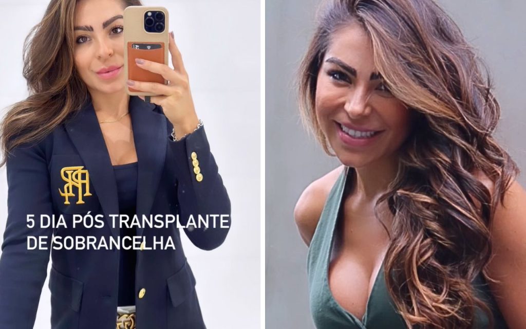 Andressa Ferreira explica processo de transplante de sobrancelha. Fotos!