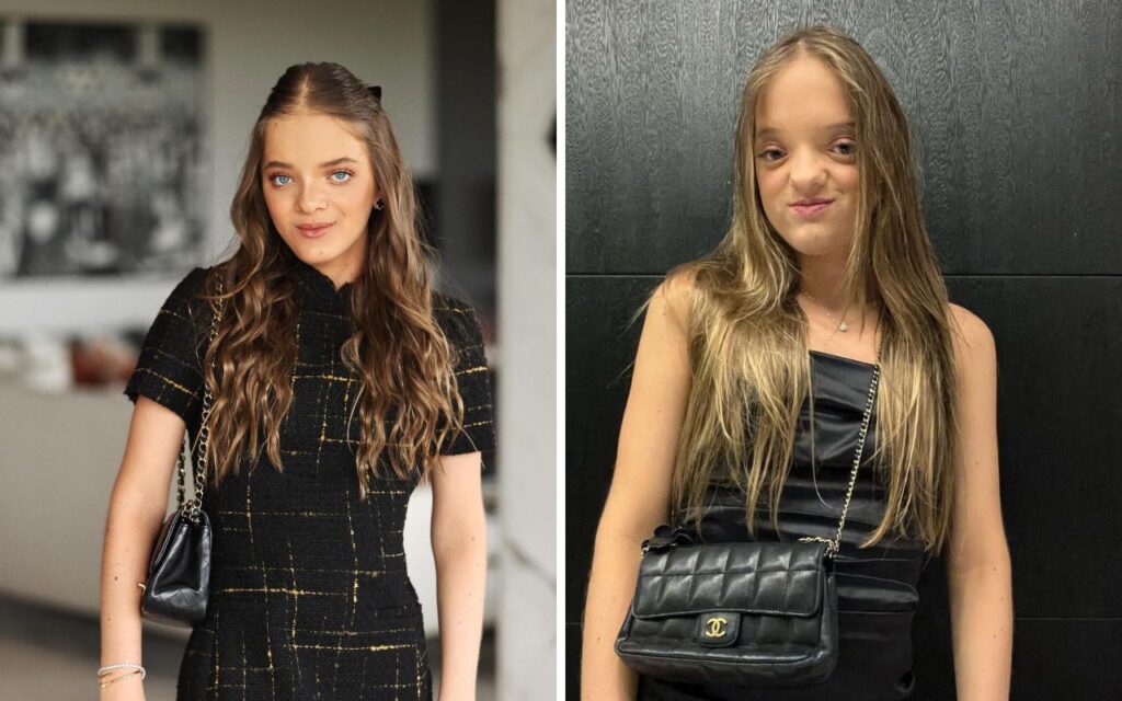 Rafaella Justus antes e depois da cirurgia