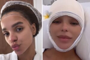 Brunna Gonçalves faz cirurgia para reduzir a testa