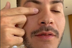 arthur aguiar passando leite materno no olho com terçol