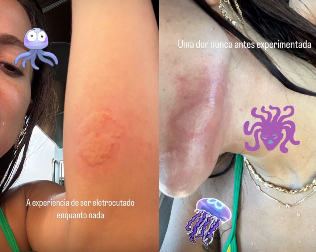 Anitta enfrenta ataque de água-viva em Ibiza 