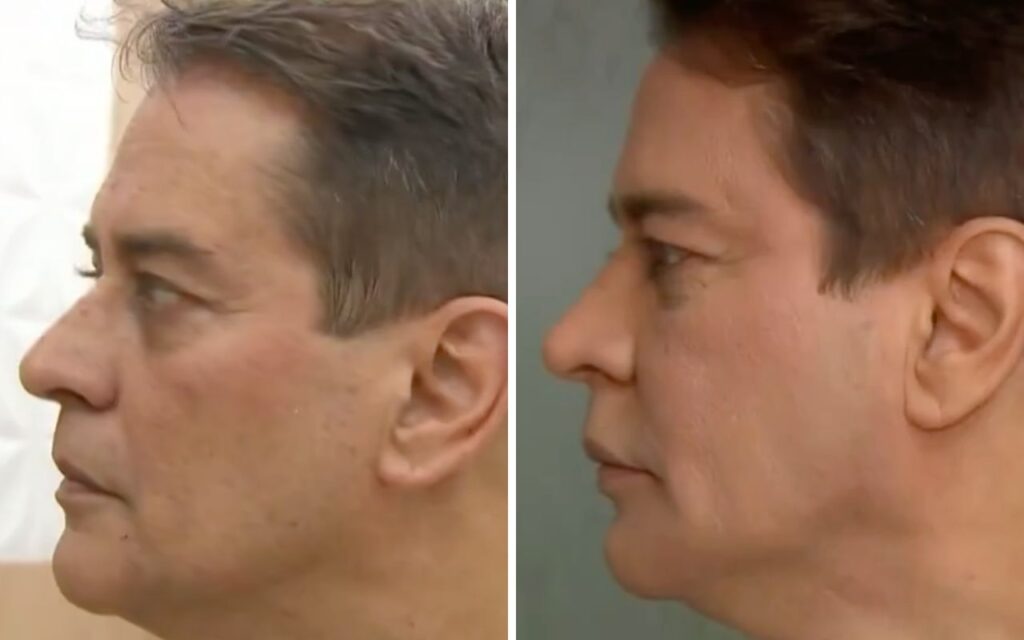 Marcello Antony faz harmonização facial. Veja o resultado!