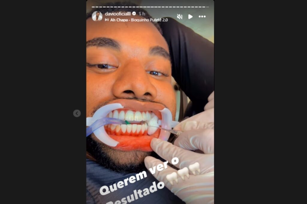 Davi Brito colocando prótese dentária