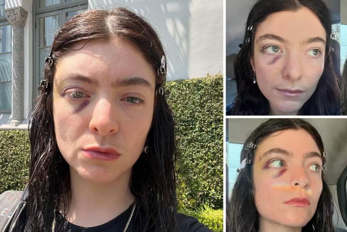 Cantora Lorde com hematomas no rosto