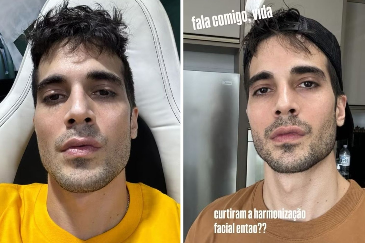 Fiuk - harmonização facial